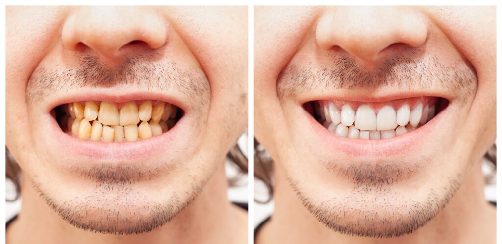 Laag bevind zich Ontdek Thuis Tanden Bleken | Witte Tanden In 1 Minuut (TIP) - VraagDeTandarts.nl